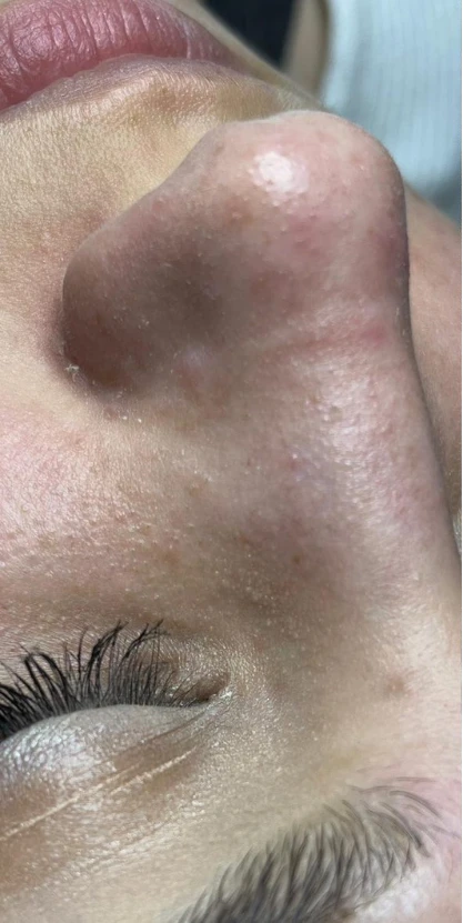 Skóra przed zabiegiem oczyszczania wodorowego